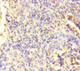 Immunohistochemistry of paraffin-embedded human cervical cancer using CAC08381 at dilution of 1:100