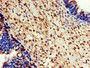 Immunohistochemistry of paraffin-embedded human ovarian cancer using CAC08385 at dilution of 1:100