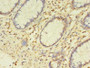 Immunohistochemistry of paraffin-embedded human colon cancer using CAC08410 at dilution of 1:100 Immunohistochemistry of paraffin-embedded human colon cancer using CAC08410 at dilution of 1:100