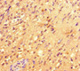 Immunohistochemistry of paraffin-embedded human glioma using CAC08562 at dilution of 1:100