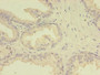 Immunohistochemistry of paraffin-embedded human prostate cancer using CAC08648 at dilution of 1:100