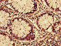 Immunohistochemistry of paraffin-embedded human colon cancer using CAC08779 at dilution of 1:100 Immunohistochemistry of paraffin-embedded human colon cancer using CAC08779 at dilution of 1:100
