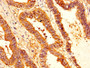IHC image diluted at 1:200 and staining in paraffin-embedded human colon cancer performed on a Leica BondTM system. After dewaxing and hydration, antigen retrieval was mediated by high pressure in a citrate buffer (pH 6.0). Section was blocked with 10% normal goat serum 30min at RT. Then primary antibody (1% BSA) was incubated at 4°C overnight. The primary is detected by a biotinylated secondary antibody and visualized using an HRP conjugated SP system. IHC image diluted at 1:200 and staining in paraffin-embedded human colon cancer performed on a Leica BondTM system. After dewaxing and hydration, antigen retrieval was mediated by high pressure in a citrate buffer (pH 6.0). Section was blocked with 10% normal goat serum 30min at RT. Then primary antibody (1% BSA) was incubated at 4°C overnight. The primary is detected by a biotinylated secondary antibody and visualized using an HRP conjugated SP system.