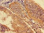Immunohistochemistry of paraffin-embedded human endometrial cancer using CAC08849 at dilution of 1:100 Immunohistochemistry of paraffin-embedded human endometrial cancer using CAC08849 at dilution of 1:100
