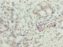 Immunohistochemistry of paraffin-embedded human pancreatic cancer using CAC08889 at dilution of 1:100 Immunohistochemistry of paraffin-embedded human pancreatic cancer using CAC08889 at dilution of 1:100