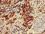 Immunohistochemistry of paraffin-embedded human bladder cancer using CAC09005 at dilution of 1:100 Immunohistochemistry of paraffin-embedded human bladder cancer using CAC09005 at dilution of 1:100