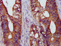 IHC image diluted at 1:1200 and staining in paraffin-embedded human colon cancer performed on a Leica BondTM system. After dewaxing and hydration, antigen retrieval was mediated by high pressure in a citrate buffer (pH 6.0). Section was blocked with 10% normal goat serum 30min at RT. Then primary antibody (1% BSA) was incubated at 4°C overnight. The primary is detected by a biotinylated secondary antibody and visualized using an HRP conjugated SP system. IHC image diluted at 1:1200 and staining in paraffin-embedded human colon cancer performed on a Leica BondTM system. After dewaxing and hydration, antigen retrieval was mediated by high pressure in a citrate buffer (pH 6.0). Section was blocked with 10% normal goat serum 30min at RT. Then primary antibody (1% BSA) was incubated at 4°C overnight. The primary is detected by a biotinylated secondary antibody and visualized using an HRP conjugated SP system.