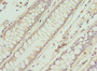 Immunohistochemistry of paraffin-embedded human colon cancer using CAC09082 at dilution of 1:100 Immunohistochemistry of paraffin-embedded human colon cancer using CAC09082 at dilution of 1:100