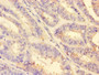 Immunohistochemistry of paraffin-embedded human endometrial cancer using CAC09087 at dilution of 1:100 Immunohistochemistry of paraffin-embedded human endometrial cancer using CAC09087 at dilution of 1:100