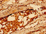 Immunohistochemistry of paraffin-embedded human breast cancer using CAC09109 at dilution of 1:100 Immunohistochemistry of paraffin-embedded human breast cancer using CAC09109 at dilution of 1:100