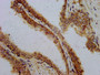 IHC image of CAC09114 diluted at 1:700 and staining in paraffin-embedded human prostate cancer performed on a Leica BondTM system. After dewaxing and hydration, antigen retrieval was mediated by high pressure in a citrate buffer (pH 6.0). Section was blocked with 10% normal goat serum 30min at RT. Then primary antibody (1% BSA) was incubated at 4°C overnight. The primary is detected by a biotinylated secondary antibody and visualized using an HRP conjugated SP system.