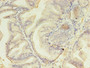 Immunohistochemistry of paraffin-embedded human prostate cancerusing CAC09134 at dilution of 1:100 Immunohistochemistry of paraffin-embedded human prostate cancerusing CAC09134 at dilution of 1:100