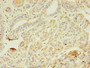 Immunohistochemistry of paraffin-embedded human breast cancer using CAC09134 at dilution of 1:100 Immunohistochemistry of paraffin-embedded human breast cancer using CAC09134 at dilution of 1:100