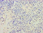 Immunohistochemistry of paraffin-embedded human breast cancer using CAC09136 at dilution of 1:100 Immunohistochemistry of paraffin-embedded human breast cancer using CAC09136 at dilution of 1:100