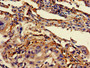 Immunohistochemistry of paraffin-embedded human lung cancer using CAC09162 at dilution of 1:100 Immunohistochemistry of paraffin-embedded human lung cancer using CAC09162 at dilution of 1:100