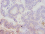 Immunohistochemistry of paraffin-embedded human colon cancer using CAC09186 at dilution of 1:100