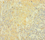 Immunohistochemistry of paraffin-embedded human lung cancer using CAC09191 at dilution of 1:100 Immunohistochemistry of paraffin-embedded human lung cancer using CAC09191 at dilution of 1:100