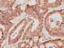 IHC image of CAC09204 diluted at 1:709 and staining in paraffin-embedded human colon cancer performed on a Leica BondTM system. After dewaxing and hydration, antigen retrieval was mediated by high pressure in a citrate buffer (pH 6.0). Section was blocked with 10% normal goat serum 30min at RT. Then primary antibody (1% BSA) was incubated at 4°C overnight. The primary is detected by a biotinylated secondary antibody and visualized using an HRP conjugated SP system.