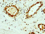 IHC image diluted at 1:400 and staining in paraffin-embedded human breast cancer performed on a Leica BondTM system. After dewaxing and hydration, antigen retrieval was mediated by high pressure in a citrate buffer (pH 6.0). Section was blocked with 10% normal goat serum 30min at RT. Then primary antibody (1% BSA) was incubated at 4°C overnight. The primary is detected by a biotinylated secondary antibody and visualized using an HRP conjugated SP system. IHC image diluted at 1:400 and staining in paraffin-embedded human breast cancer performed on a Leica BondTM system. After dewaxing and hydration, antigen retrieval was mediated by high pressure in a citrate buffer (pH 6.0). Section was blocked with 10% normal goat serum 30min at RT. Then primary antibody (1% BSA) was incubated at 4°C overnight. The primary is detected by a biotinylated secondary antibody and visualized using an HRP conjugated SP system.