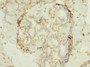 Immunohistochemistry of paraffin-embedded human breast cancer using CAC09269 at dilution of 1:100 Immunohistochemistry of paraffin-embedded human breast cancer using CAC09269 at dilution of 1:100