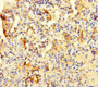 Immunohistochemistry of paraffin-embedded human lung cancer using CAC09299 at dilution of 1:100 Immunohistochemistry of paraffin-embedded human lung cancer using CAC09299 at dilution of 1:100