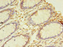 Immunohistochemistry of paraffin-embedded human colon cancer using CAC09355 at dilution of 1:100 Immunohistochemistry of paraffin-embedded human colon cancer using CAC09355 at dilution of 1:100