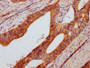 IHC image diluted at 1:400 and staining in paraffin-embedded human colon cancer performed on a Leica BondTM system. After dewaxing and hydration, antigen retrieval was mediated by high pressure in a citrate buffer (pH 6.0). Section was blocked with 10% normal goat serum 30min at RT. Then primary antibody (1% BSA) was incubated at 4°C overnight. The primary is detected by a biotinylated secondary antibody and visualized using an HRP conjugated SP system. IHC image diluted at 1:400 and staining in paraffin-embedded human colon cancer performed on a Leica BondTM system. After dewaxing and hydration, antigen retrieval was mediated by high pressure in a citrate buffer (pH 6.0). Section was blocked with 10% normal goat serum 30min at RT. Then primary antibody (1% BSA) was incubated at 4°C overnight. The primary is detected by a biotinylated secondary antibody and visualized using an HRP conjugated SP system.