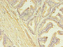 Immunohistochemistry of paraffin-embedded human prostate cancer using CAC09414 at dilution of 1:100 Immunohistochemistry of paraffin-embedded human prostate cancer using CAC09414 at dilution of 1:100