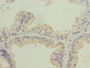 Immunohistochemistry of paraffin-embedded human prostate cancer using CAC09434 at dilution of 1:100 Immunohistochemistry of paraffin-embedded human prostate cancer using CAC09434 at dilution of 1:100