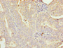 Immunohistochemistry of paraffin-embedded human endometrial cancer using CAC09438 at dilution of 1:100 Immunohistochemistry of paraffin-embedded human endometrial cancer using CAC09438 at dilution of 1:100