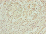 Immunohistochemistry of paraffin-embedded human pancreatic cancer using CAC09445 at dilution of 1:100 Immunohistochemistry of paraffin-embedded human pancreatic cancer using CAC09445 at dilution of 1:100