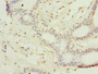Immunohistochemistry of paraffin-embedded human breast cancer using CAC09455 at dilution of 1:100 Immunohistochemistry of paraffin-embedded human breast cancer using CAC09455 at dilution of 1:100