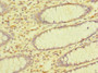 Immunohistochemistry of paraffin-embedded human colon cancer using CAC09477 at dilution of 1:100 Immunohistochemistry of paraffin-embedded human colon cancer using CAC09477 at dilution of 1:100