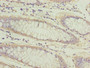 Immunohistochemistry of paraffin-embedded human colon cancer using CAC09537 at dilution of 1:100 Immunohistochemistry of paraffin-embedded human colon cancer using CAC09537 at dilution of 1:100