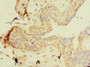 Immunohistochemistry of paraffin-embedded human breast cancer using CAC09612 at dilution of 1:100