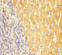 Immunohistochemistry of paraffin-embedded human liver cancer using CAC09624 at dilution of 1:100