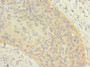 Immunohistochemistry of paraffin-embedded human cervical cancer using CAC09664 at dilution of 1:100 Immunohistochemistry of paraffin-embedded human cervical cancer using CAC09664 at dilution of 1:100