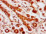 IHC image diluted at 1:1000 and staining in paraffin-embedded human breast cancer performed on a Leica BondTM system. After dewaxing and hydration, antigen retrieval was mediated by high pressure in a citrate buffer (pH 6.0). Section was blocked with 10% normal goat serum 30min at RT. Then primary antibody (1% BSA) was incubated at 4°C overnight. The primary is detected by a biotinylated secondary antibody and visualized using an HRP conjugated SP system.