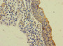 Immunohistochemistry of paraffin-embedded human bladder cancer using CAC09811 at dilution of 1:100