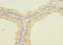 Immunohistochemistry of paraffin-embedded human prostate cancer using CAC09811 at dilution of 1:100
