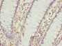 Immunohistochemistry of paraffin-embedded human colon cancer using CAC09815 at dilution of 1:100