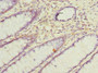 Immunohistochemistry of paraffin-embedded human colon cancer using CAC09816 at dilution of 1:100