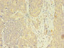 Immunohistochemistry of paraffin-embedded human gastric cancer using CAC09831 at dilution of 1:100 Immunohistochemistry of paraffin-embedded human gastric cancer using CAC09831 at dilution of 1:100