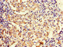 Immunohistochemistry of paraffin-embedded human lung cancer using CAC09834 at dilution of 1:100 Immunohistochemistry of paraffin-embedded human lung cancer using CAC09834 at dilution of 1:100