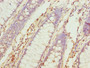 Immunohistochemistry of paraffin-embedded human colon cancer using CAC09837 at dilution of 1:100