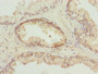 Immunohistochemistry of paraffin-embedded human prostate cancer using CAC09837 at dilution of 1:100
