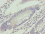 Immunohistochemistry of paraffin-embedded human colon cancer using CAC09896 at dilution of 1:100 Immunohistochemistry of paraffin-embedded human colon cancer using CAC09896 at dilution of 1:100