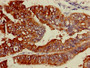 IHC image diluted at 1:600 and staining in paraffin-embedded human endometrial cancer performed on a Leica BondTM system. After dewaxing and hydration, antigen retrieval was mediated by high pressure in a citrate buffer (pH 6.0). Section was blocked with 10% normal goat serum 30min at RT. Then primary antibody (1% BSA) was incubated at 4°C overnight. The primary is detected by a biotinylated secondary antibody and visualized using an HRP conjugated SP system. IHC image diluted at 1:600 and staining in paraffin-embedded human endometrial cancer performed on a Leica BondTM system. After dewaxing and hydration, antigen retrieval was mediated by high pressure in a citrate buffer (pH 6.0). Section was blocked with 10% normal goat serum 30min at RT. Then primary antibody (1% BSA) was incubated at 4°C overnight. The primary is detected by a biotinylated secondary antibody and visualized using an HRP conjugated SP system.