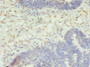 Immunohistochemistry of paraffin-embedded human ovarian cancer using CAC09962 at dilution of 1:100