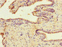 Immunohistochemistry of paraffin-embedded human prostate cancer using CAC09995 at dilution of 1:100 Immunohistochemistry of paraffin-embedded human prostate cancer using CAC09995 at dilution of 1:100